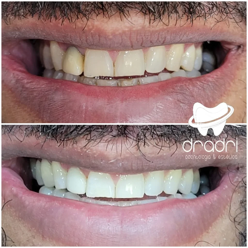 Antes e depois sorriso