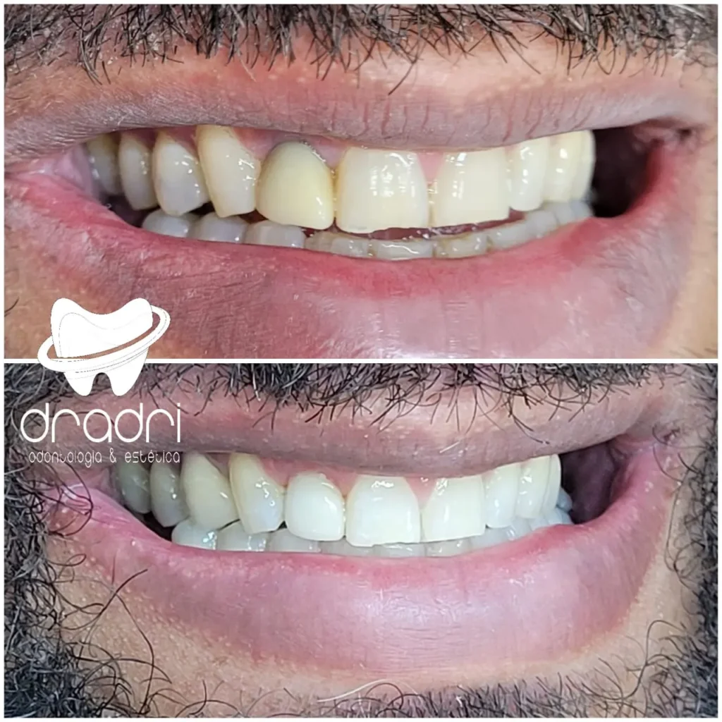 Antes e depois sorriso2