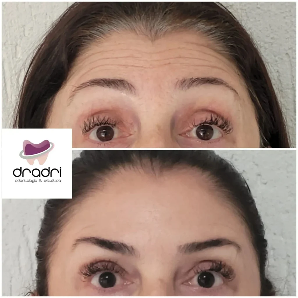 Botox (1)