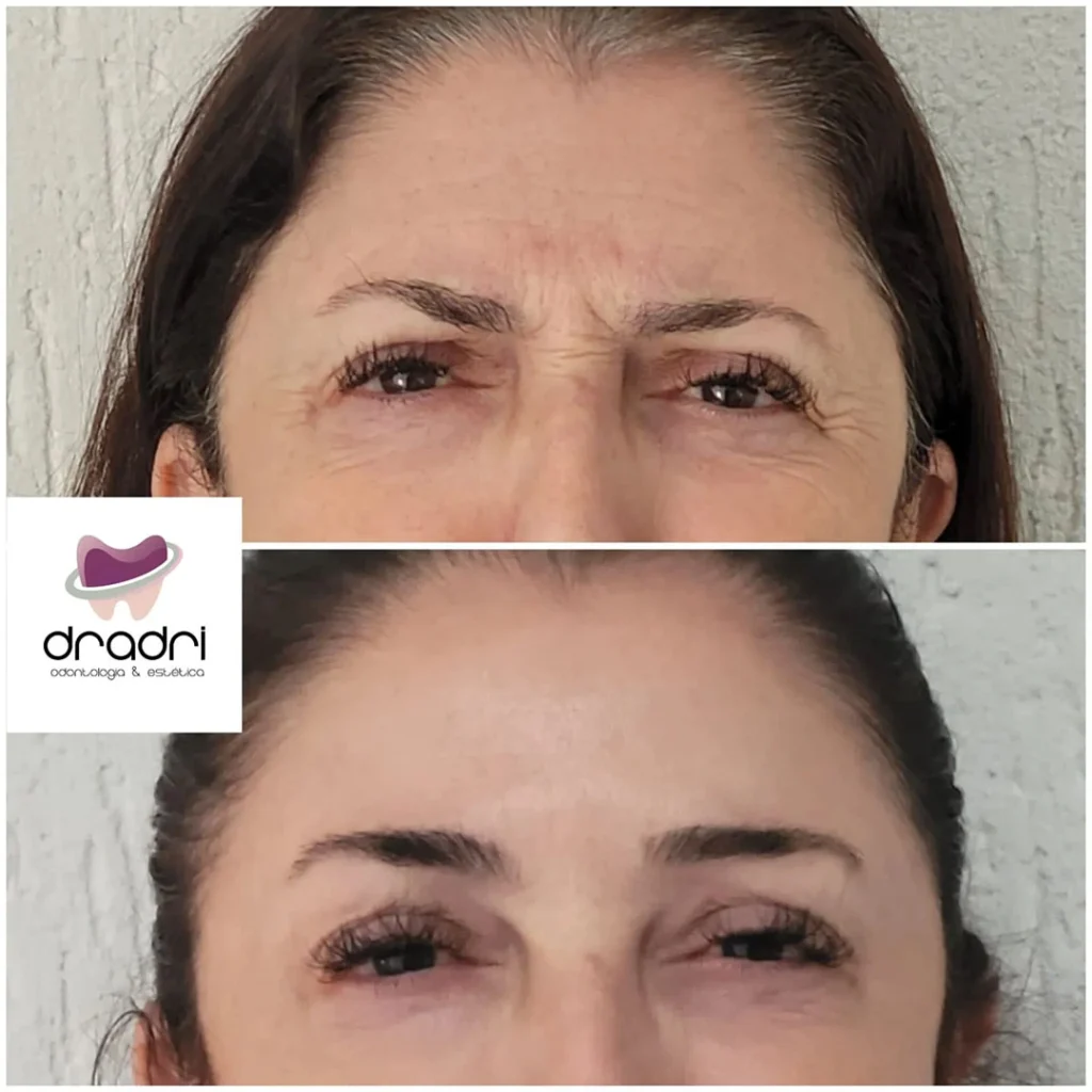 Botox 2