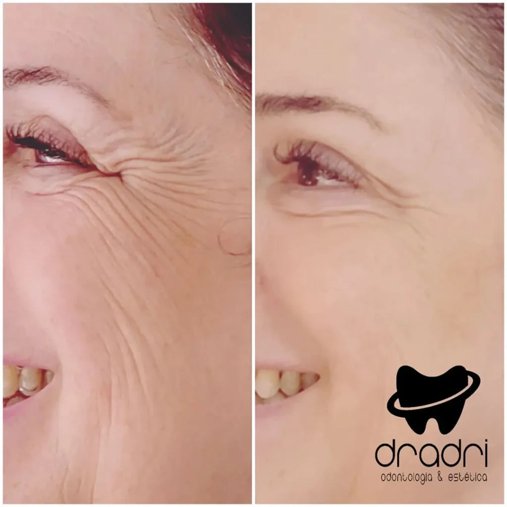 Botox 3