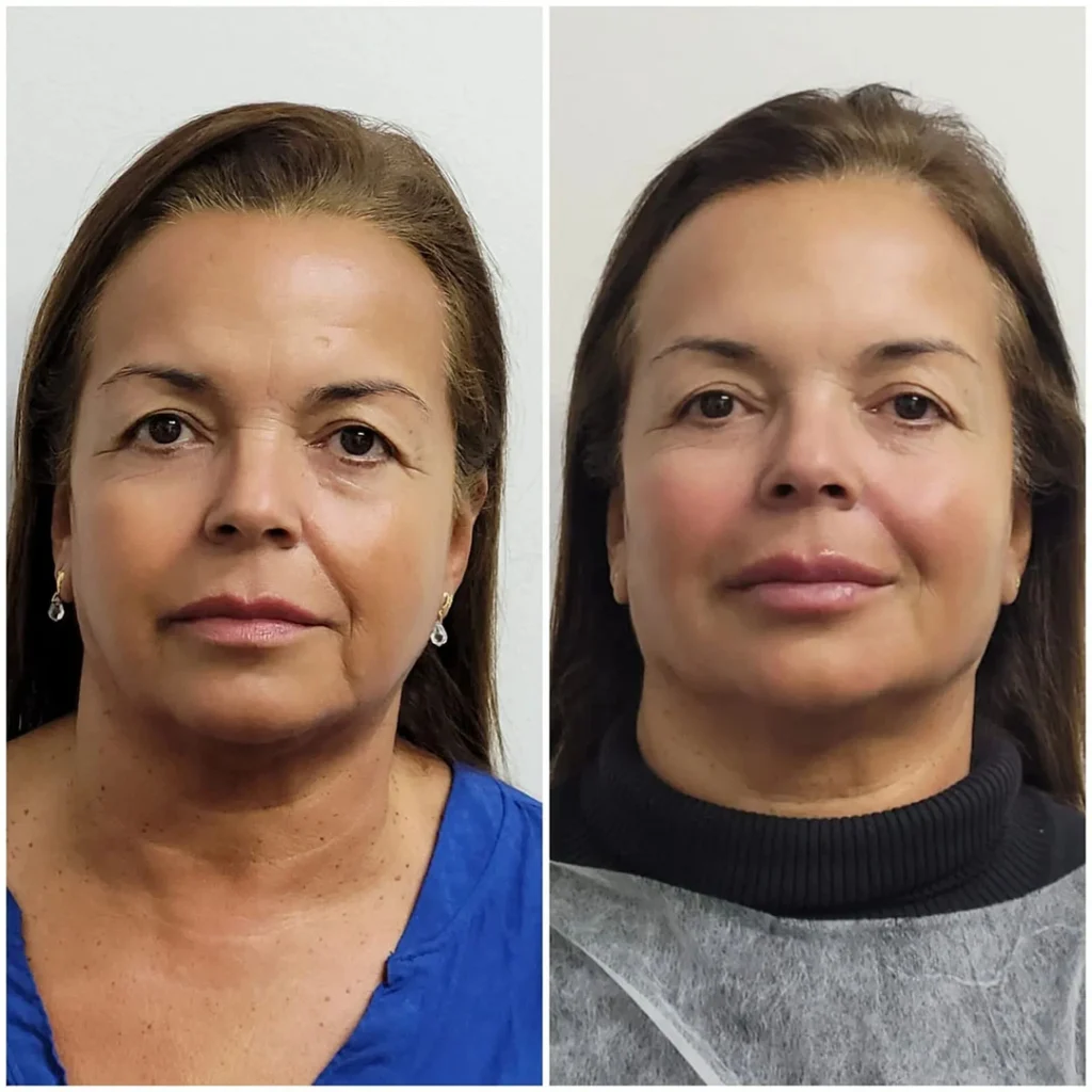 Harmonização facial
