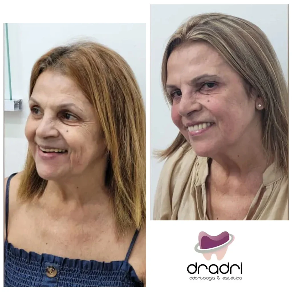 Harmonização facial 3