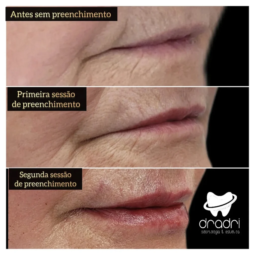 Preenchimento Labial (2)