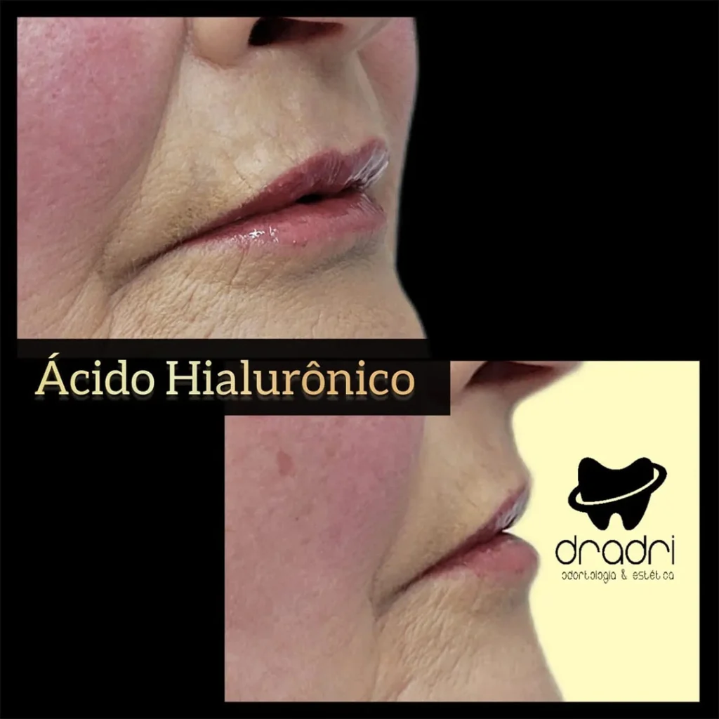 Preenchimento labial 3