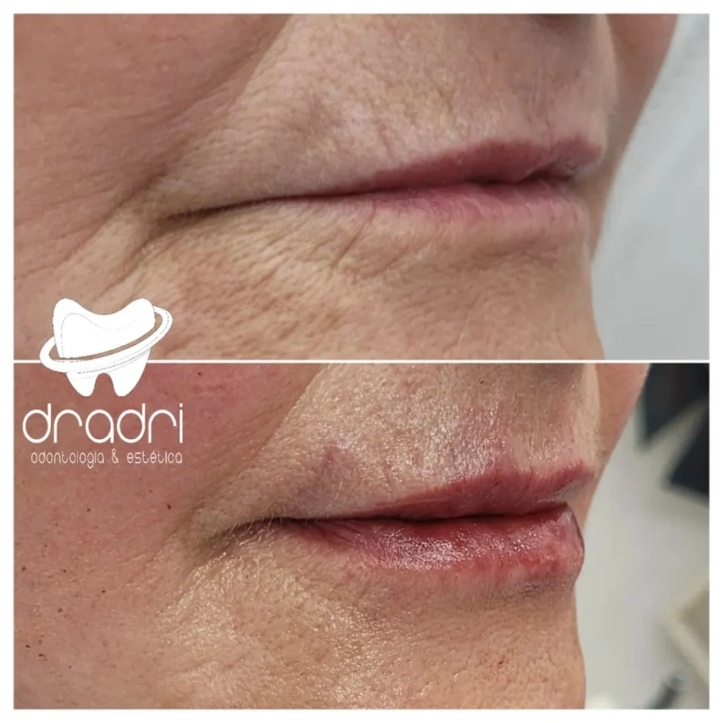 Preenchimento labial 4