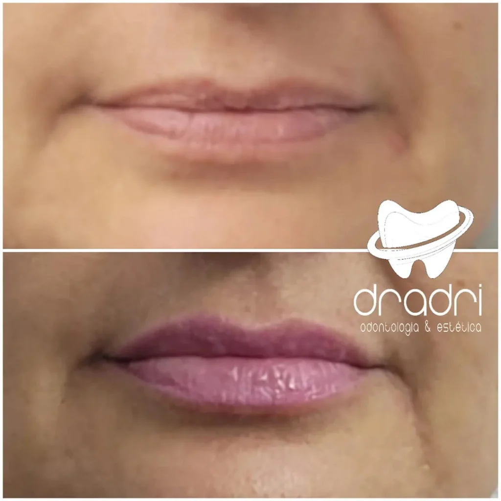 Preenchimento labial 5