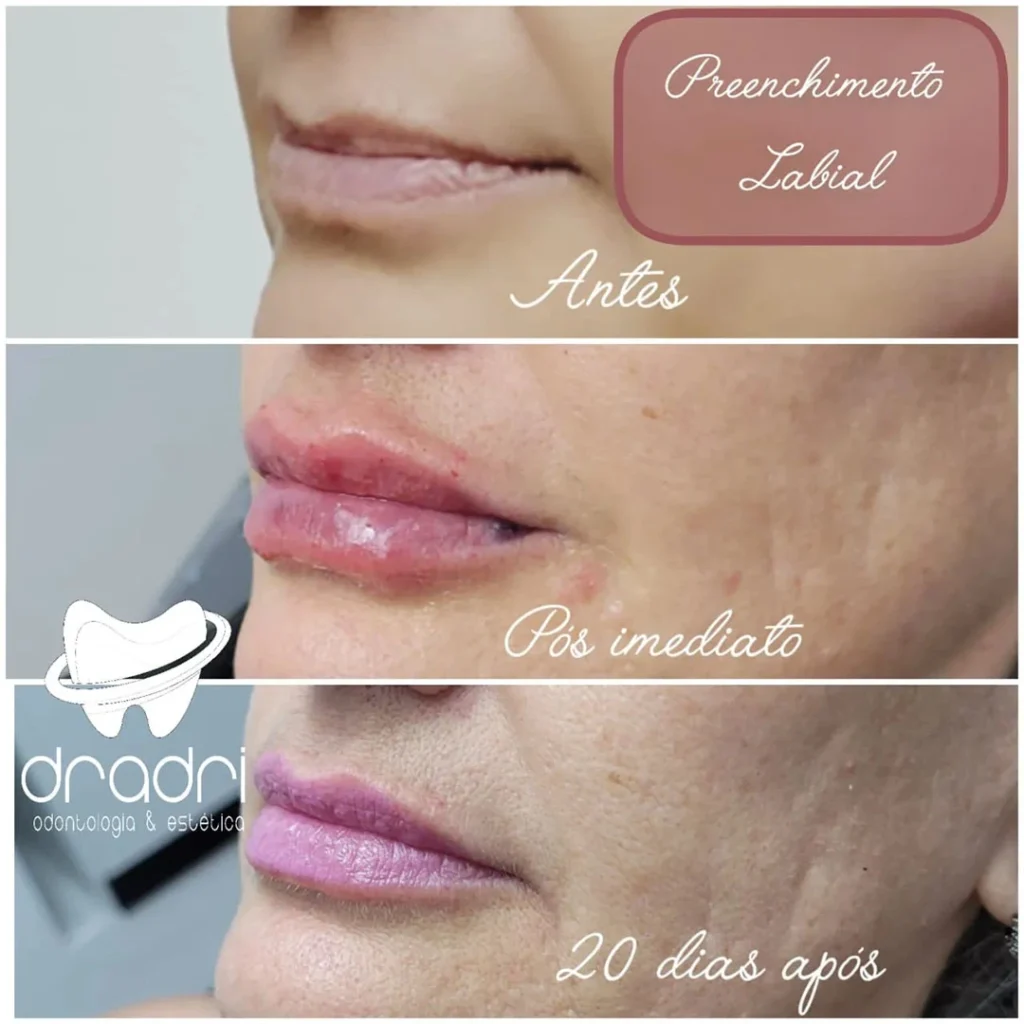 Preenchimento labial 6