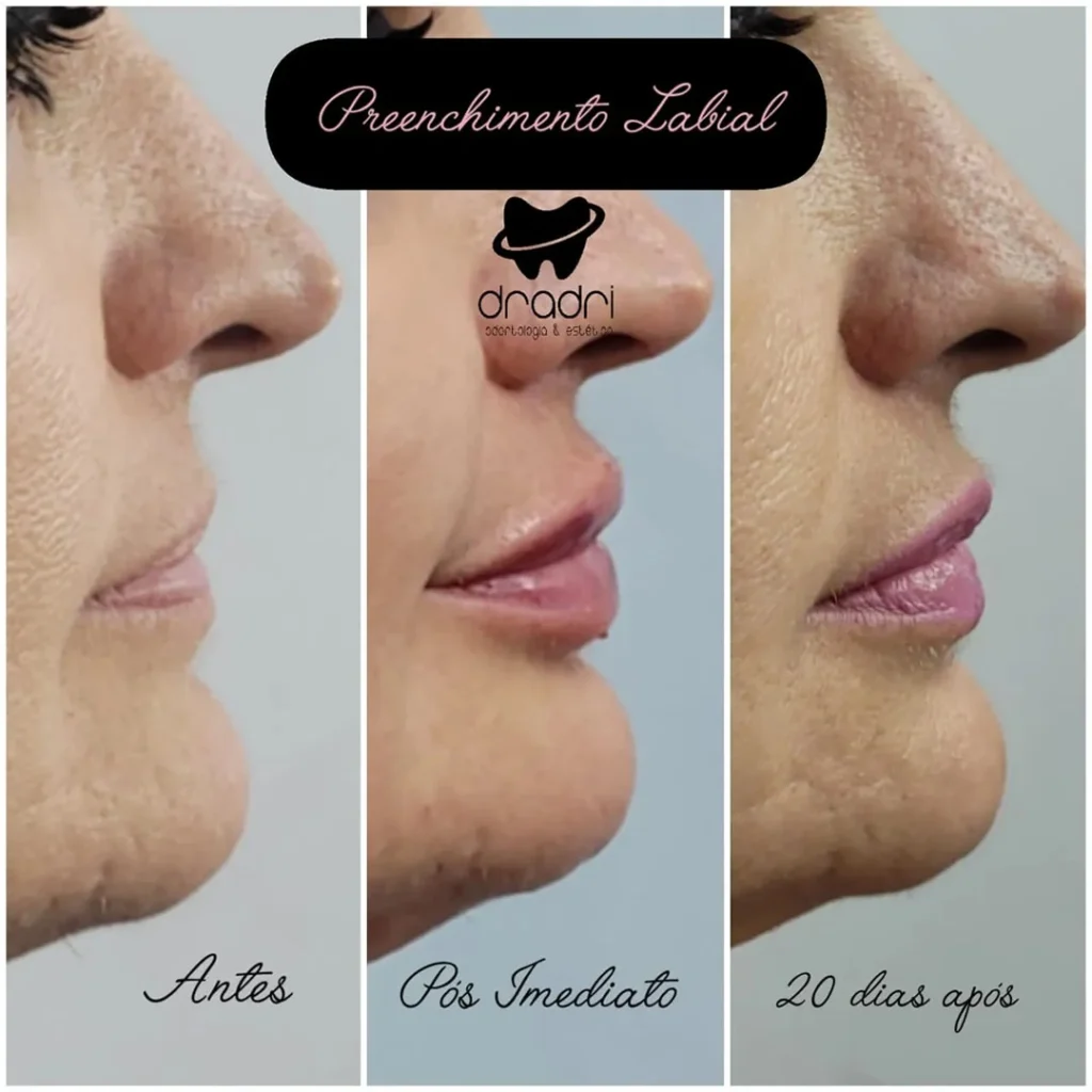 Preenchimento labial 7