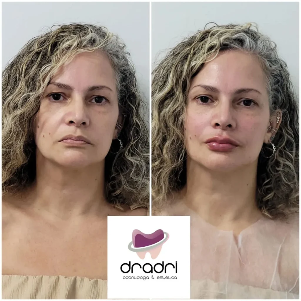 Preenchimento labial 8