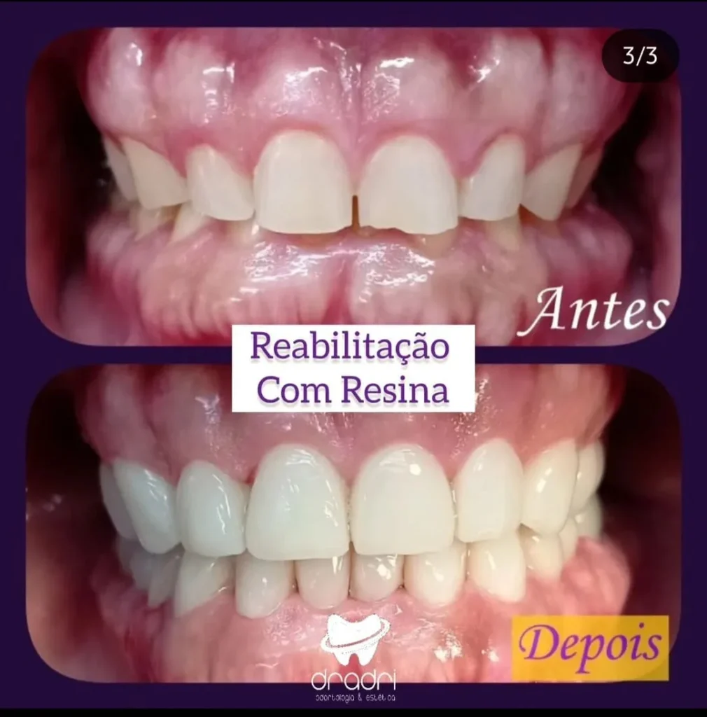 Reabilitação com resina
