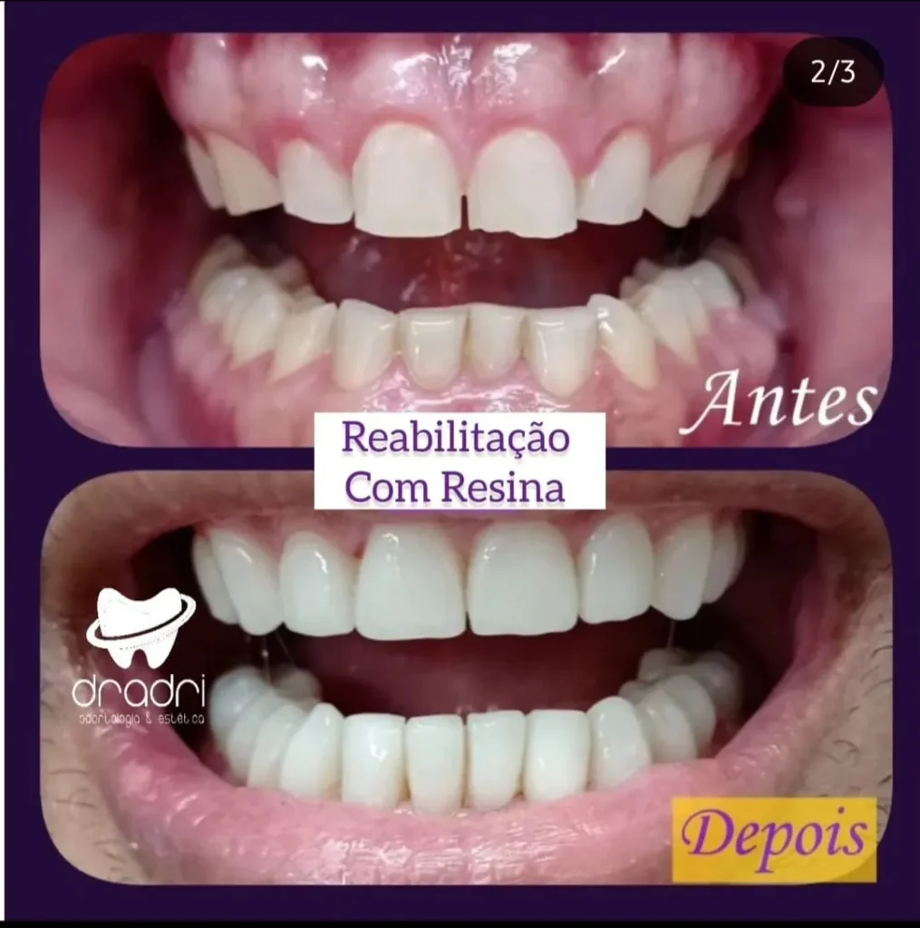 Reabilitação com resina3