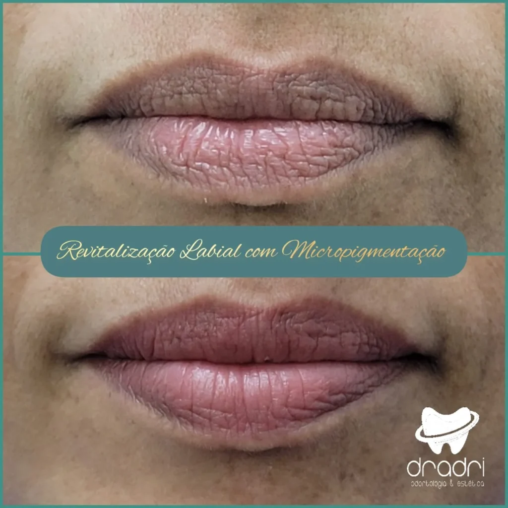 Revitalização Labial