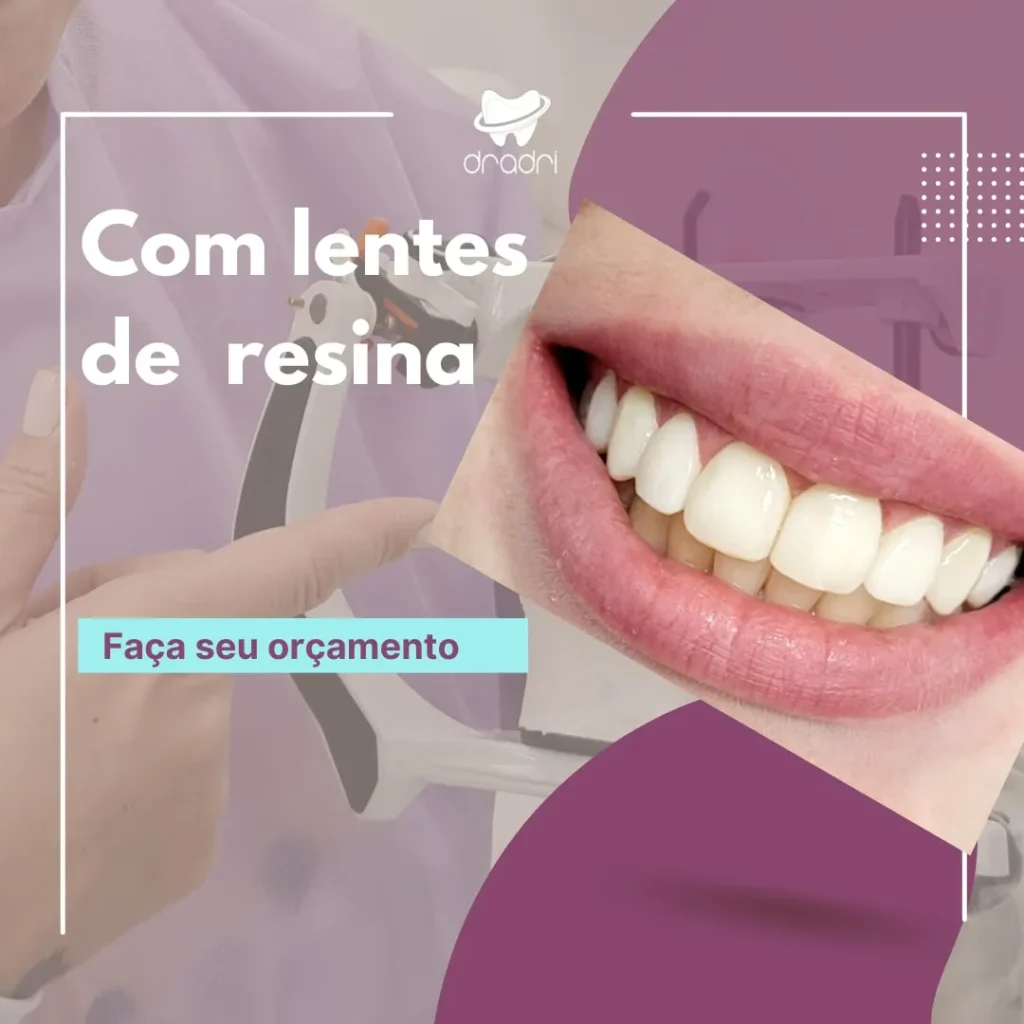 faceta de resina 2 depois