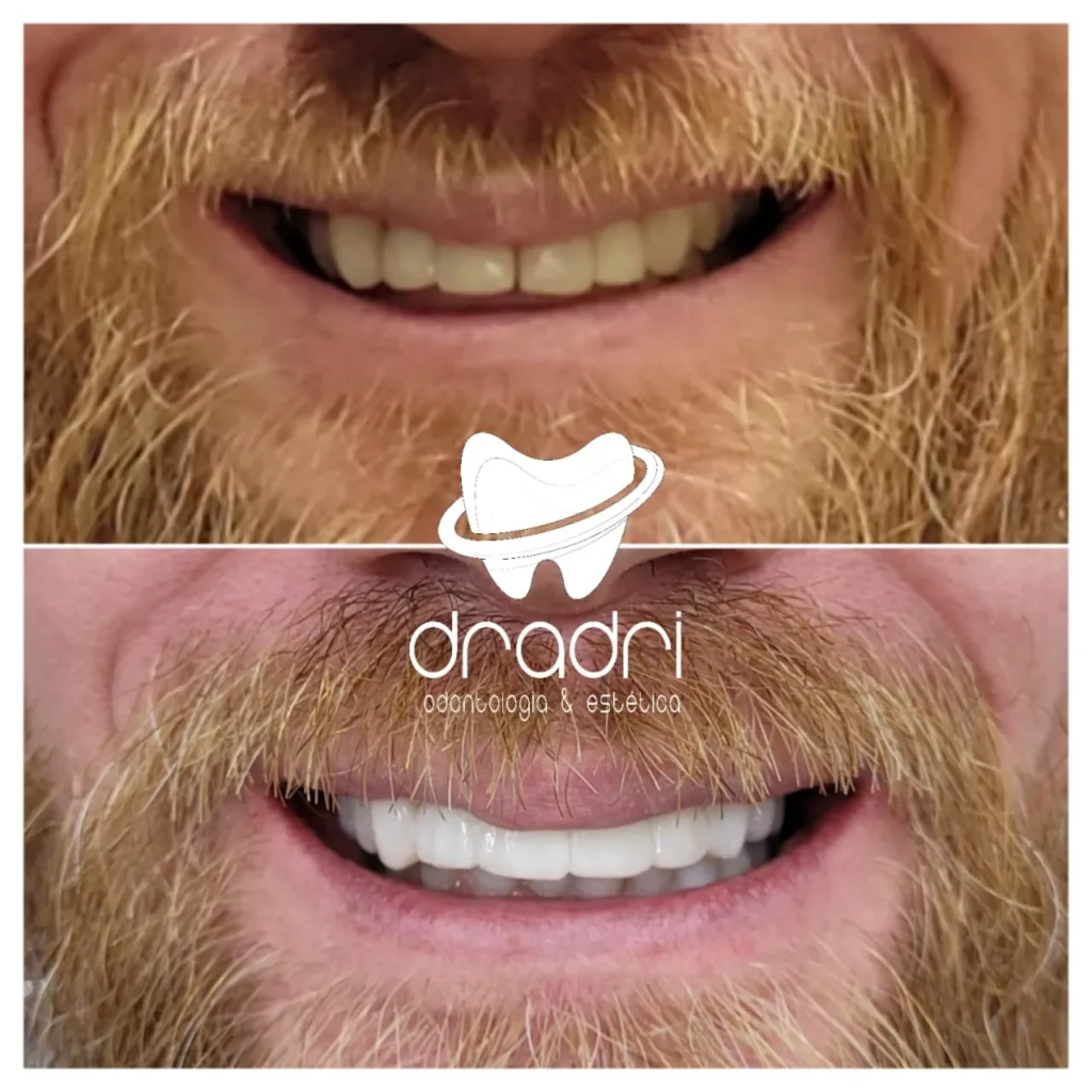 facetas em resina3jpg