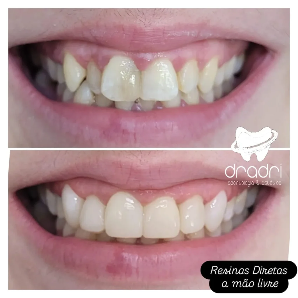 facetas em resina7jpg